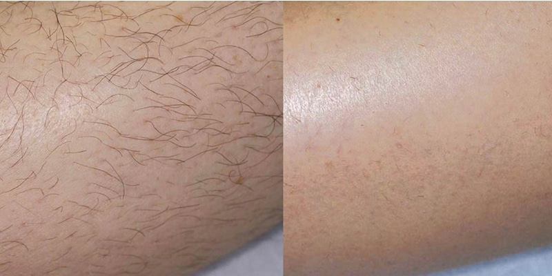 Before and After Image 3 of Laser Hair Removal Smyrna TN