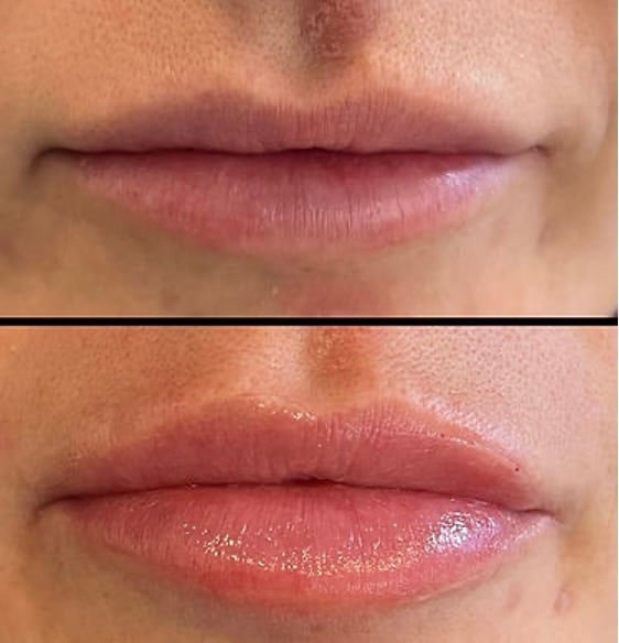 Before and After image of Lip Filler Smyrna TN