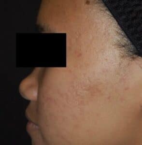 After Image: Laser Genesis