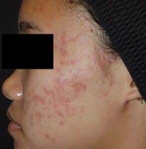 Before Image: Laser Genesis