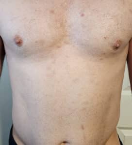 After Image: Aviclear on Front