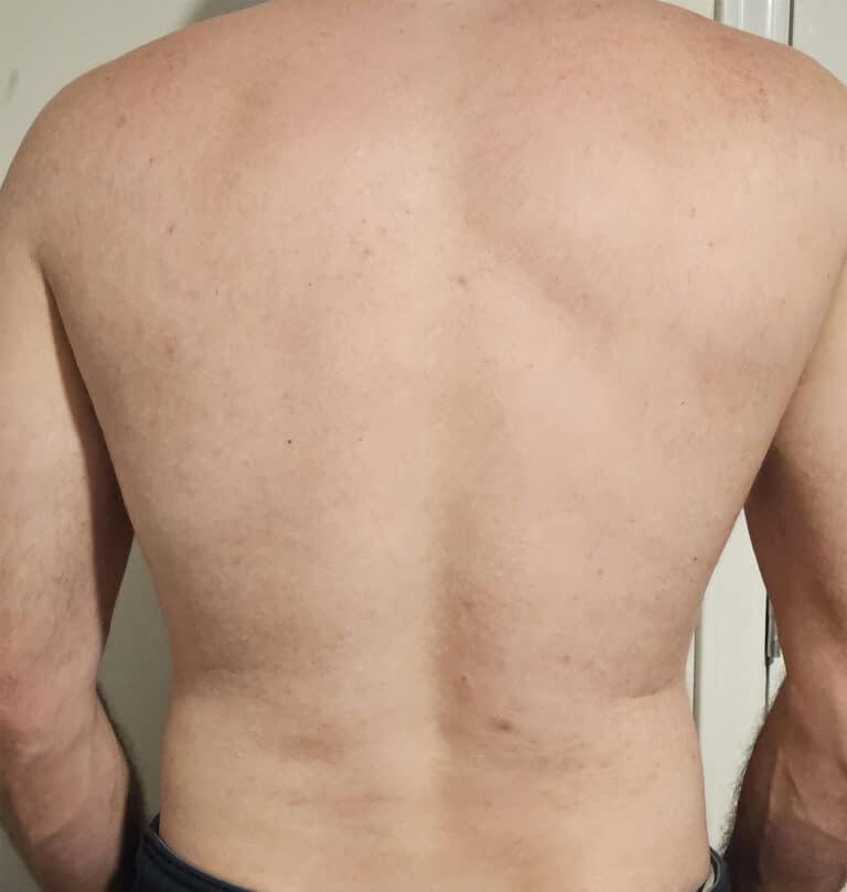 After Image: Aviclear on Back - back