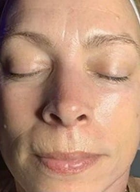 After Image: Chemical Peel - front