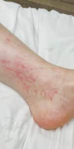 After Image: Spider veins with Cutera XEO