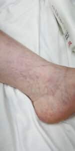 Before Image: Spider veins with Cutera XEO