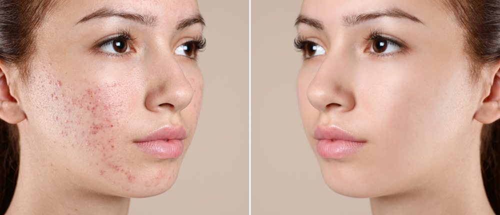 Woman with glowing skin after laser acne treatment