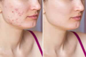 Young woman with cystic acne, before and after AviClear laser treatment