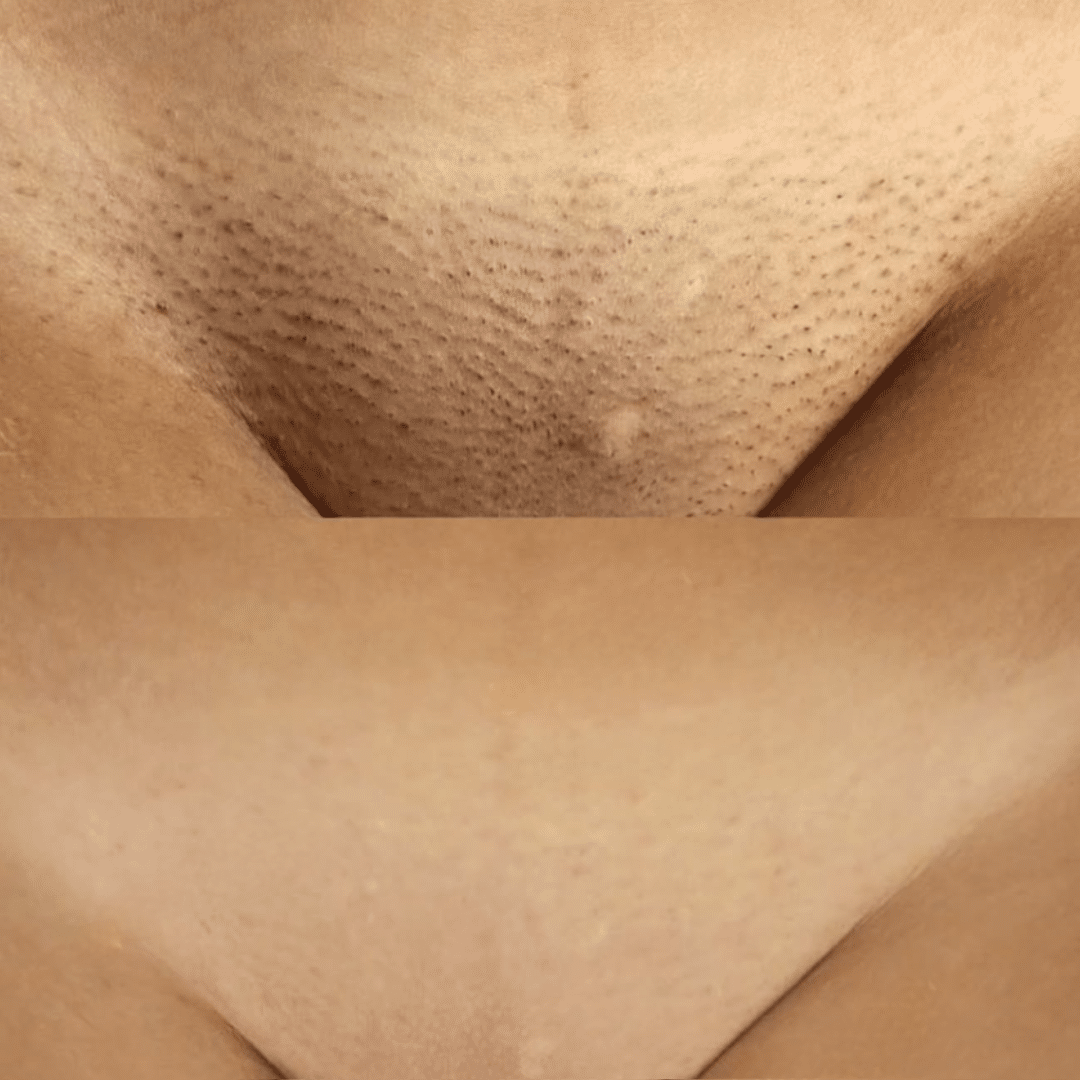 LHR Bikini BA
