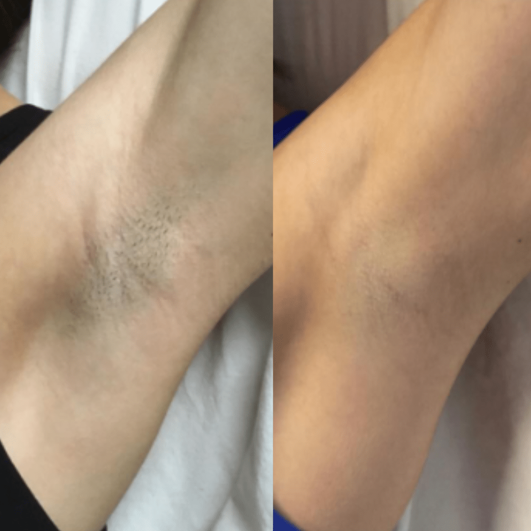LHR Underarms BA WS