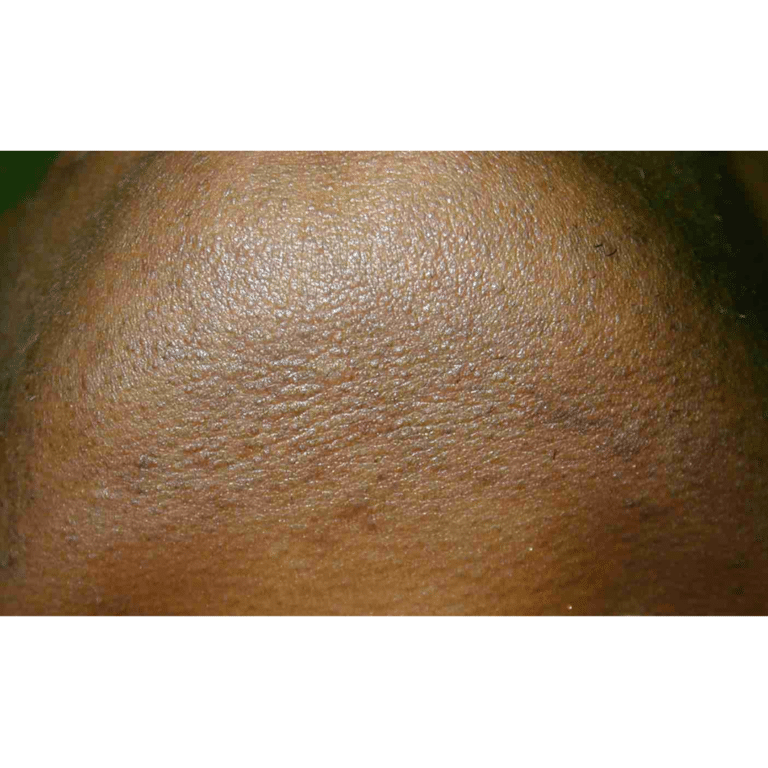 After Image: Laser Hair Removal - front