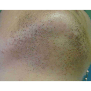 Before Image: Laser Hair Removal