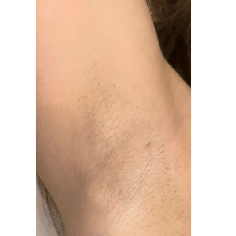After Image: Laser Hair Removal - front