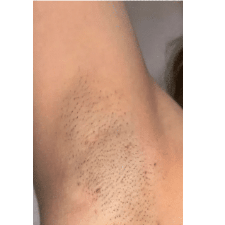 Before Image: Laser Hair Removal - front