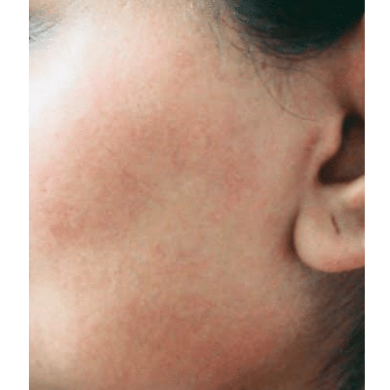 After Image: Laser Hair Removal - left-front-oblique