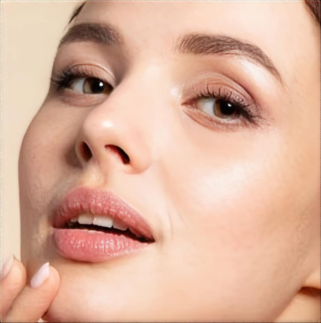 Acne (1)