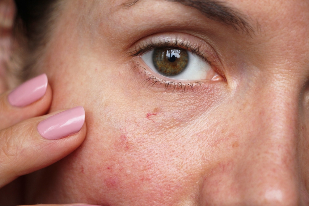 Woman touches spider veins in her cheek
