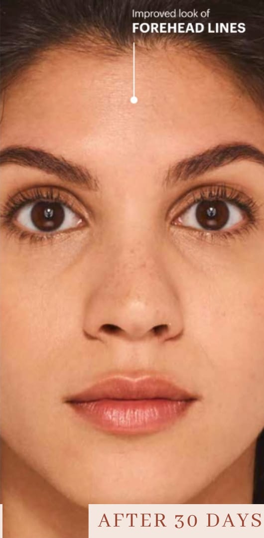 After Image: Botox - front