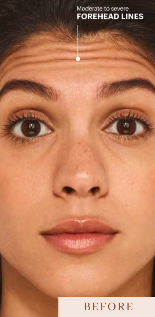 Before Image: Botox - front