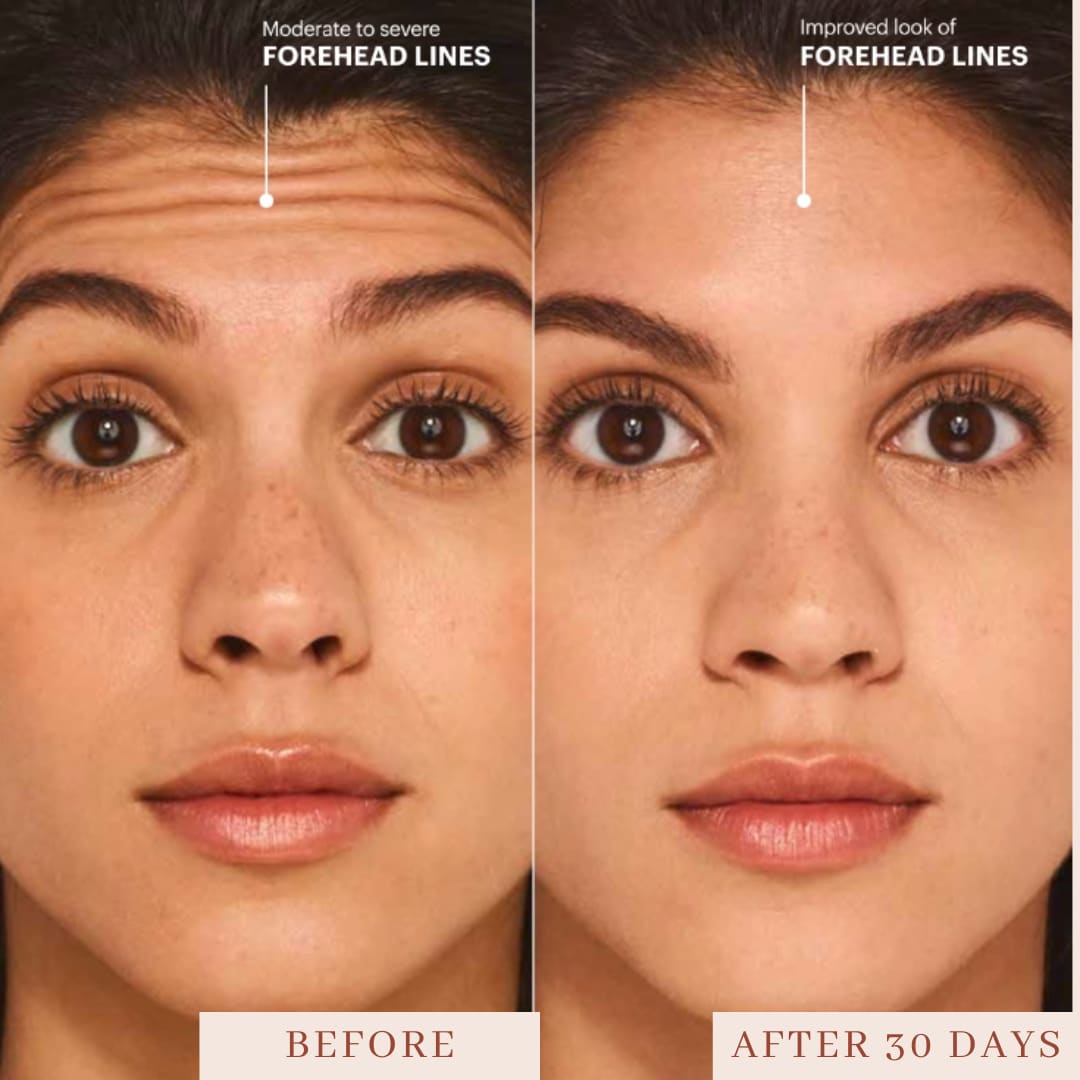 Botox Injections Smyrna TN