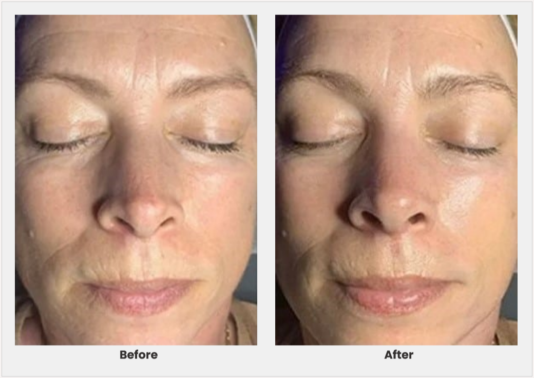 125871 Chemical Peel Cedar Grove Aesthetics 2648