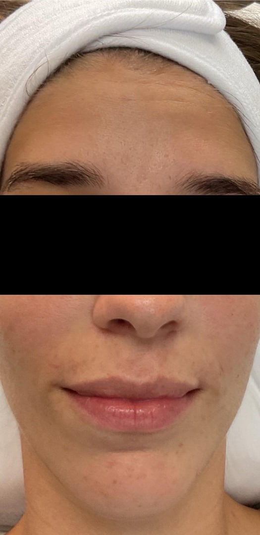 After Image: Microneedling with Skinstylus - front