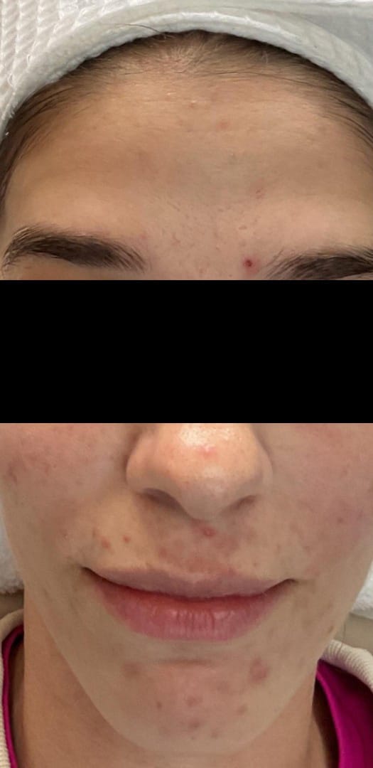 Before Image: Microneedling with Skinstylus - front