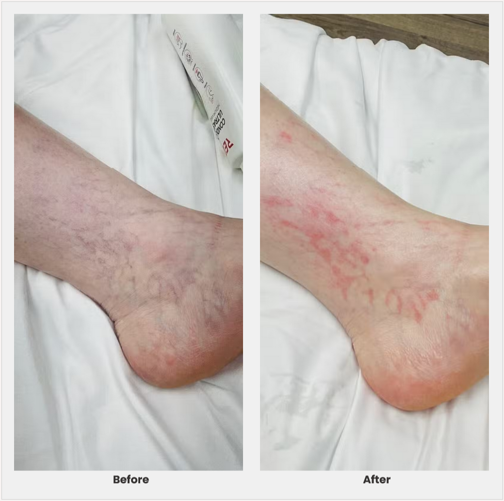 125871 Spider veins with Cutera XEO Cedar Grove Aesthetics 2924
