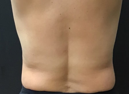 After Image: TruBody Sculpting - back