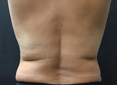 Before Image: TruBody Sculpting - back