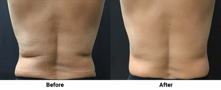 Before and after TruSculpt iD Fat Reduction Smyrna TN
