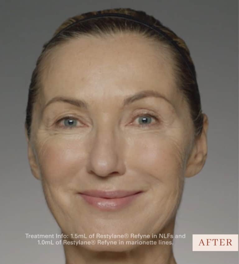 After Image: Restylane - front