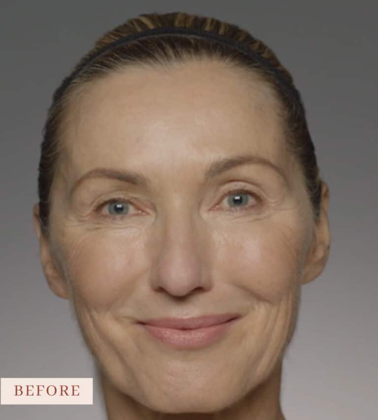 Before Image: Restylane - front