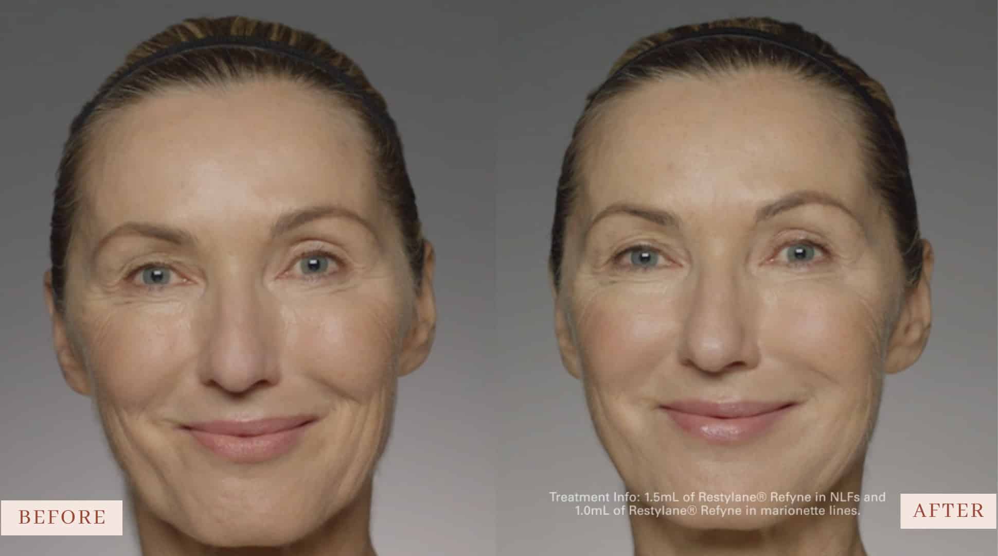 Before and after Dermal Fillers Smyrna TN