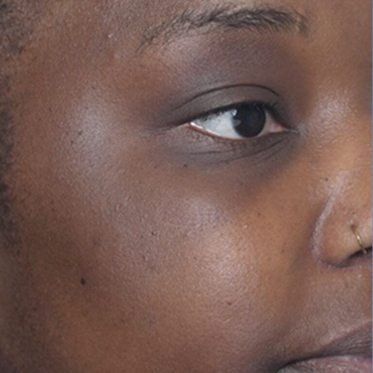 Before Image: Hydrafacial - right-front-oblique