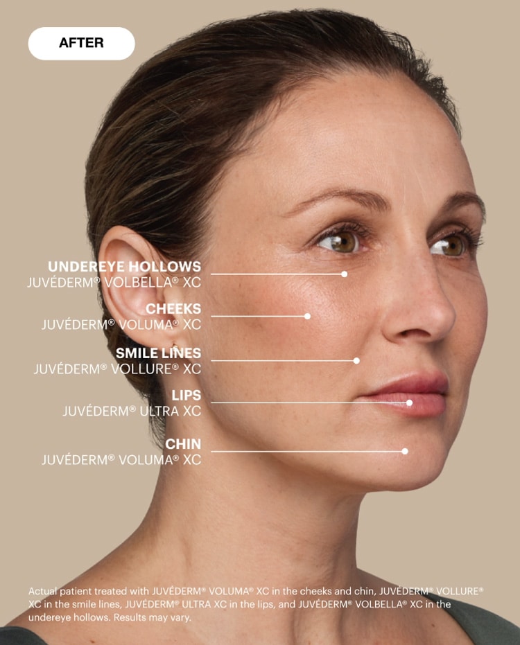 After Image: Juvederm - right-front-oblique