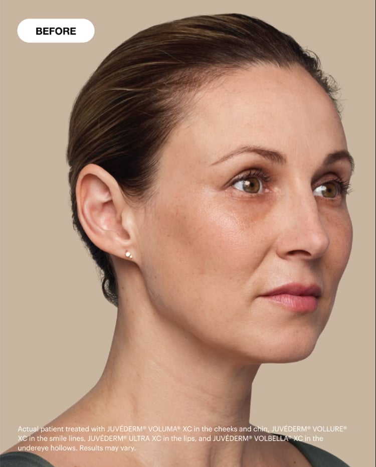 Before Image: Juvederm - right-front-oblique