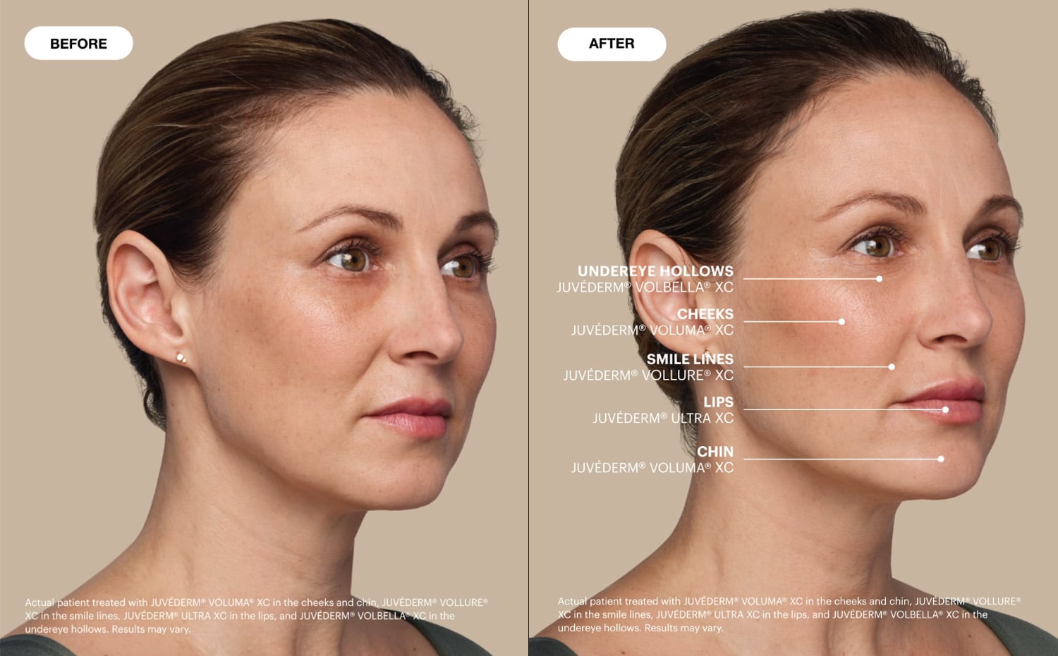 Before and after Juvederm Cosmetic Filler Smyrna TN