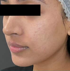 After Image: Laser Genesis