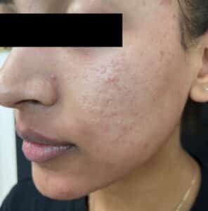 Before Image: Laser Genesis