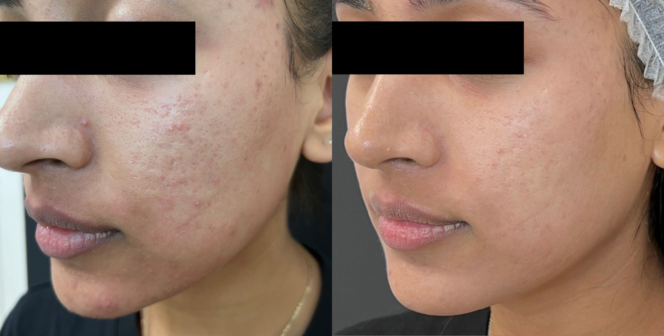 Before and after Cutera Laser Genesis Smyrna TN
