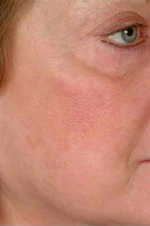 After Image: Laser Veins - right-front-oblique