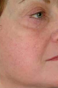 Before Image: Laser Veins