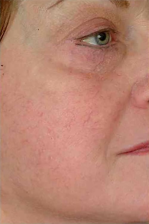 Before Image: Laser Veins - right-front-oblique