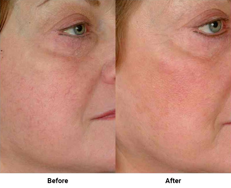 125871 laser vein feat