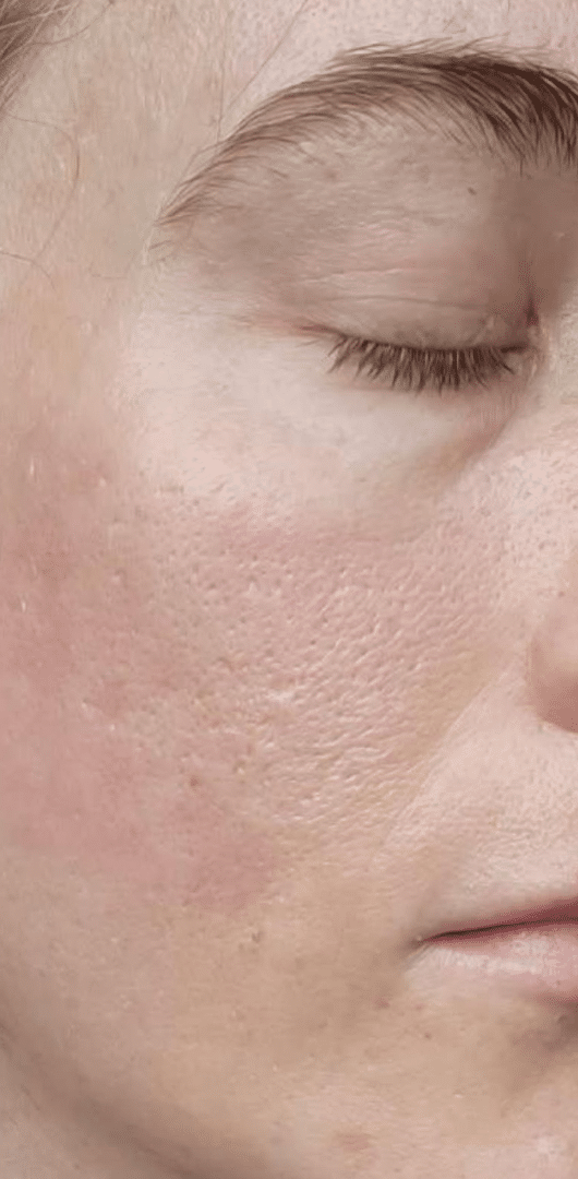 After Image: Laser Skin Resurfacing - right-front-oblique