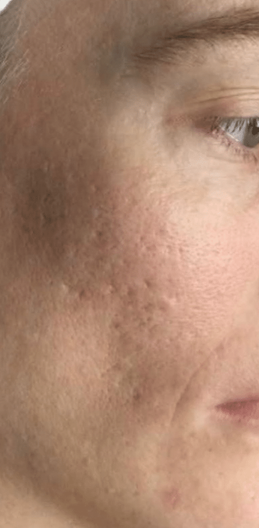 Before Image: Laser Skin Resurfacing - right-front-oblique