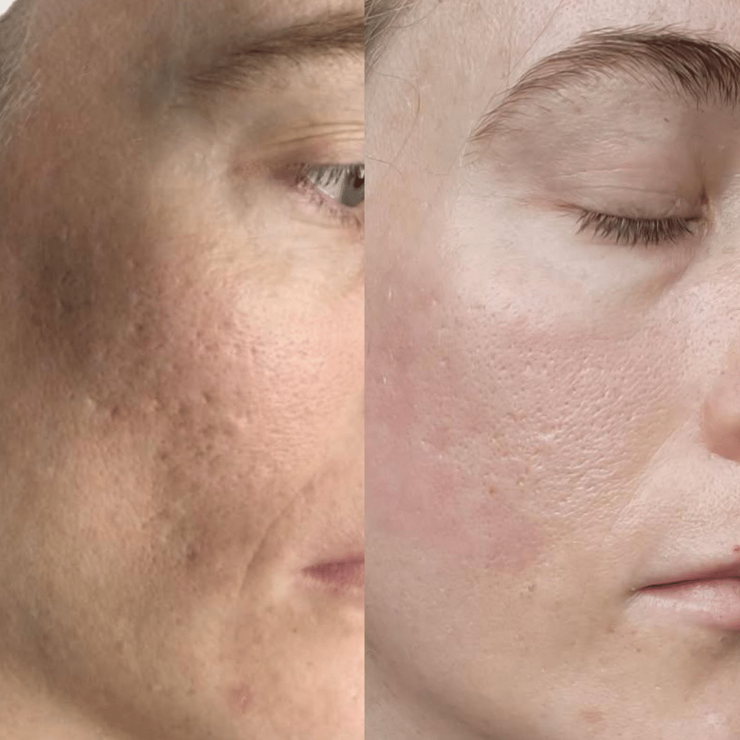 125871 plasma skin resurfacing feat