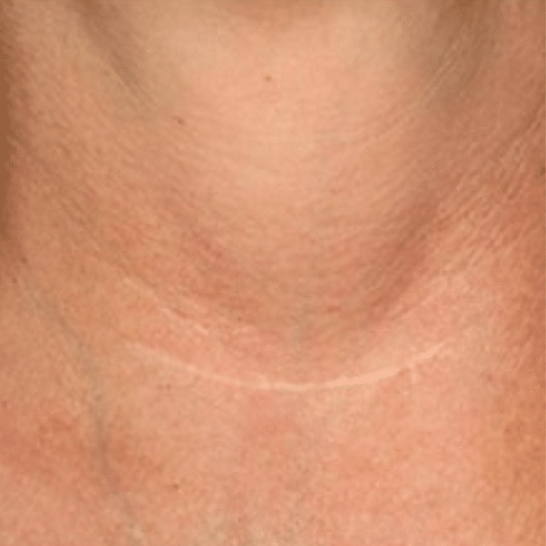After Image: Scar Treatment - front