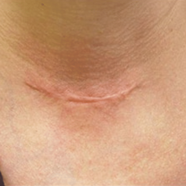 Before Image: Scar Treatment - front