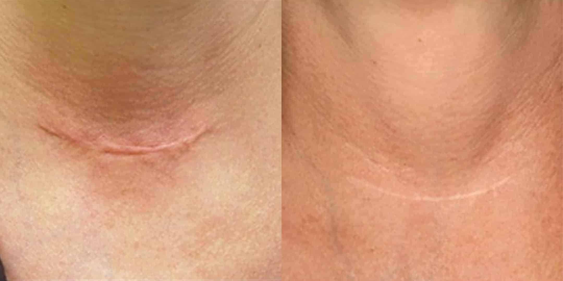 Before and after Scar Treatment Smyrna TN